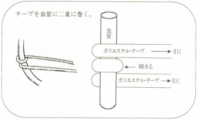 ストア テープおよび静脈